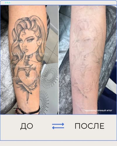 Удаление татуировки